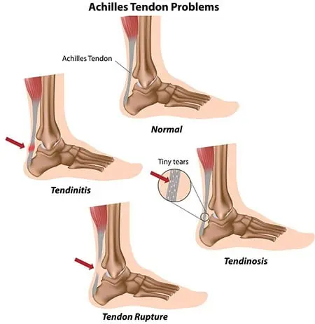 Ankle Injury Therapy