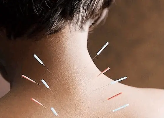 Dry Needling Treatment