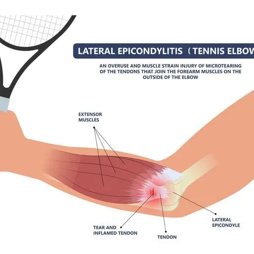 Tennis Elbow Injury